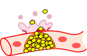 悪玉コレステロールが血管内にたまりすぎて破裂しているイラスト