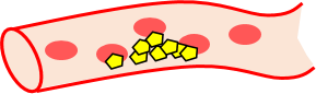 血管に悪玉コレステロールが溜まっていくイラスト