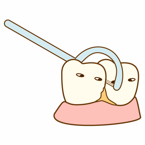 歯間ブラシで歯間の磨き方を示すイラスト