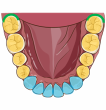 みがき残しの多い部分のイラスト