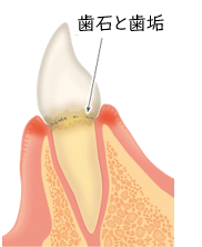 歯が傾き掛けている歯肉炎のイラスト