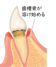歯が溶け始めている歯周病のイラスト